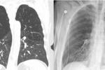 Two images of Patrisa Williams lungs showing emphysema