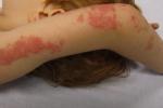 A child with a rash caused by shingles on their arm.