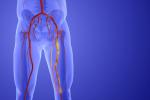 Animation of peripheral artery bypass surgery 3d illustration.