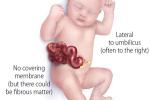 Baby with gastroschisis