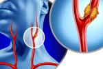 Illustration of carotid artery that shows plaque buildup inside the blocked vessel causing narrowing or stenosis.