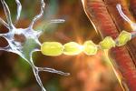 Demyelination of neuron