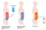 An illustration showing an IV bag of blue dialysis solution that goes into the abdomen, then a tube goes from the abdomen into a yellow container