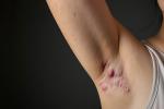 Armpit with hidradenitis suppurativa showing painful red bumps and irritated skin