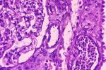 kidney disease