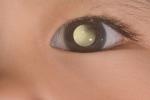 An example of leukocoria where the eye reflects a yellowish color instead of red. 