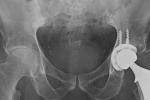 An Xray of a man getting a hip replacement