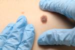 Doctor examining mole 