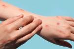 Hand and wrist with red bumps on it