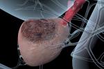 3D medical illustration of prostate cancer
