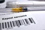 Request for biopsy Kaposi's sarcoma