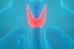 Illustration of throat cancer