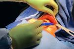 Hands of surgeon reaching in patient’s mouth marking where they will perform surgery