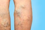 Varicose veins on female legs.